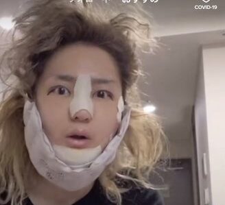 DJ社長の整形が大成功!ビフォーアフターの顔画像が別人でエグい!