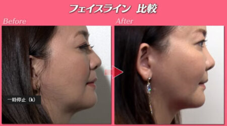 【顔画像比較】華原朋美の糸リフト整形は湘南美容外科!整形した理由はダイエットだった。